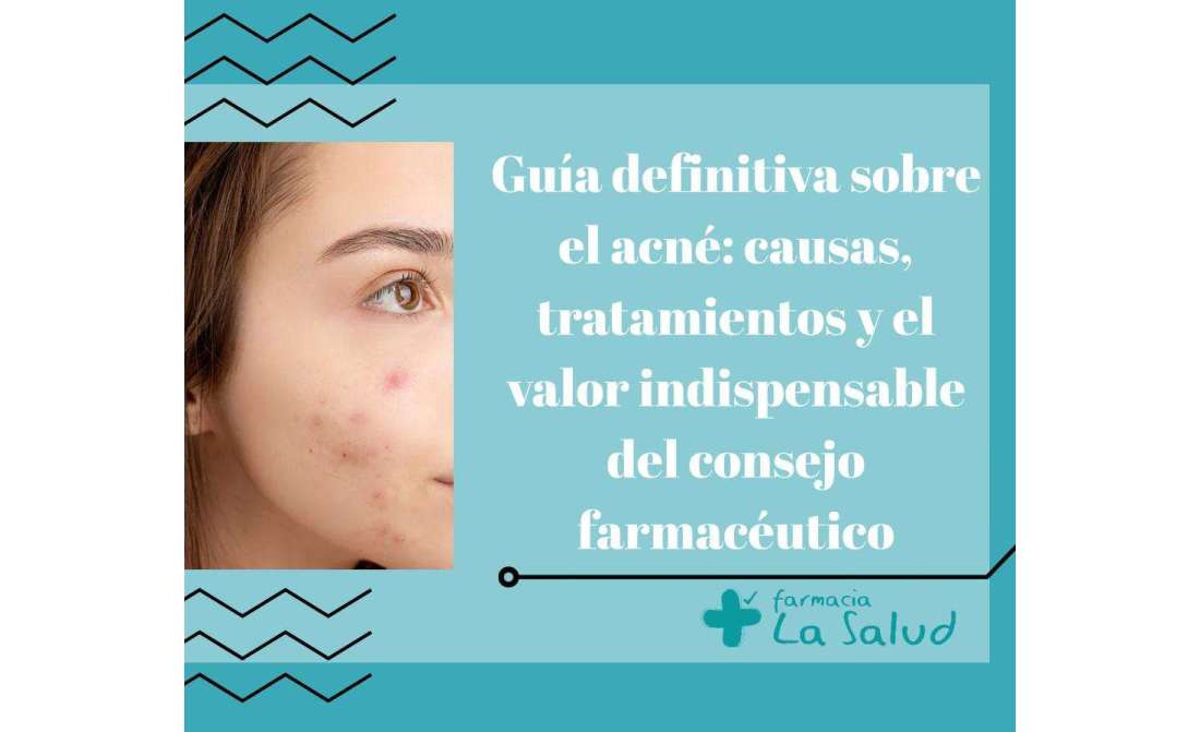 Guía definitiva sobre el acné: causas, tratamientos y el valor indispensable del consejo farmacéutico